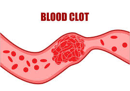 clot